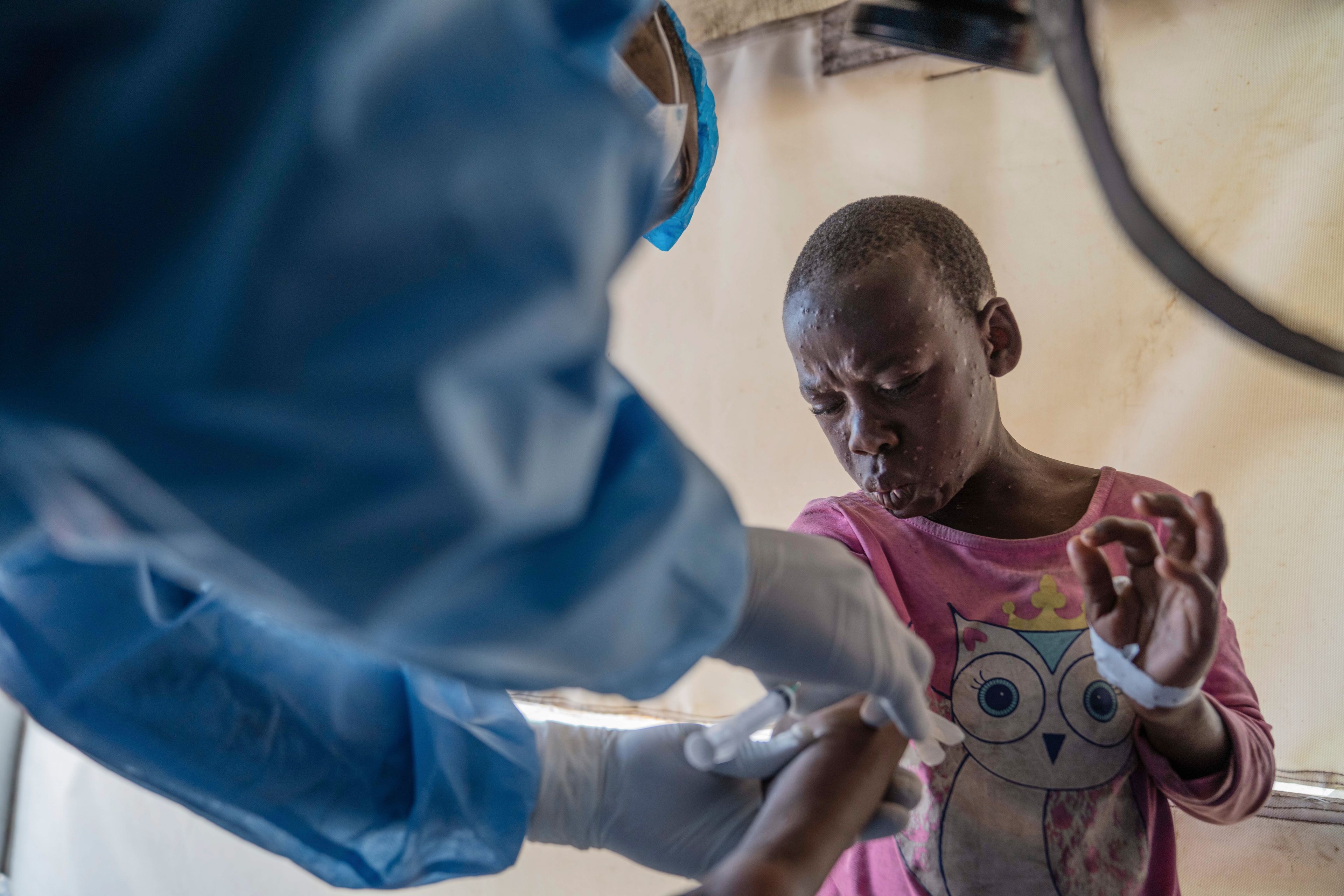 FILE - A health worker attends to a mpox patient, at a treatment centre in Munigi, eastern Congo, Aug. 19, 2024.