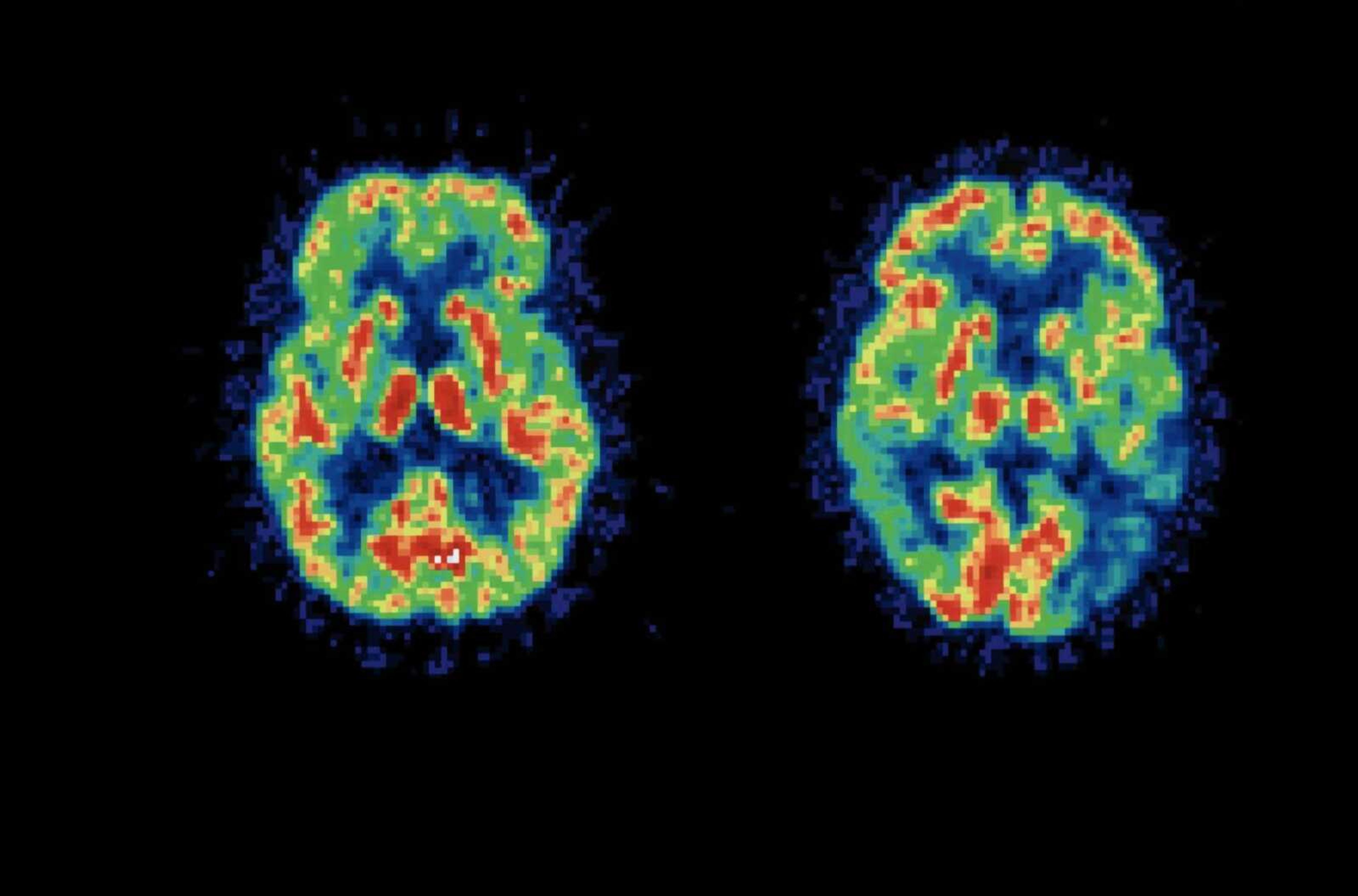 A brain scan is shown. Protein deposits around neurons in the brain can be a sign of dementia or Alzheimer's disease. (Stock photo)