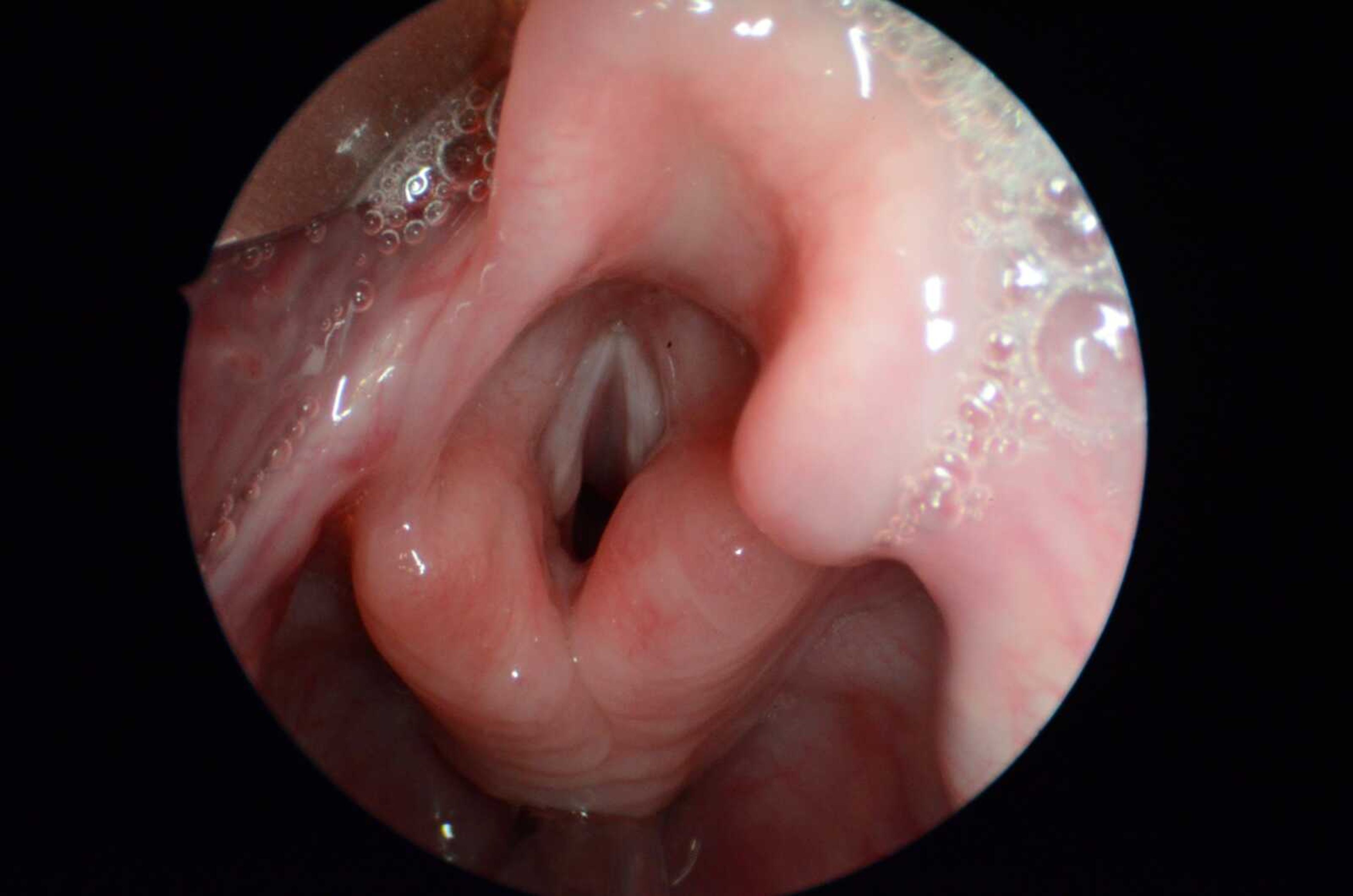 A normal larynx and vocal folds are shown during surgery in Madison, Wisconsin. (University of Wisconsin School of Medicine and Public Health)