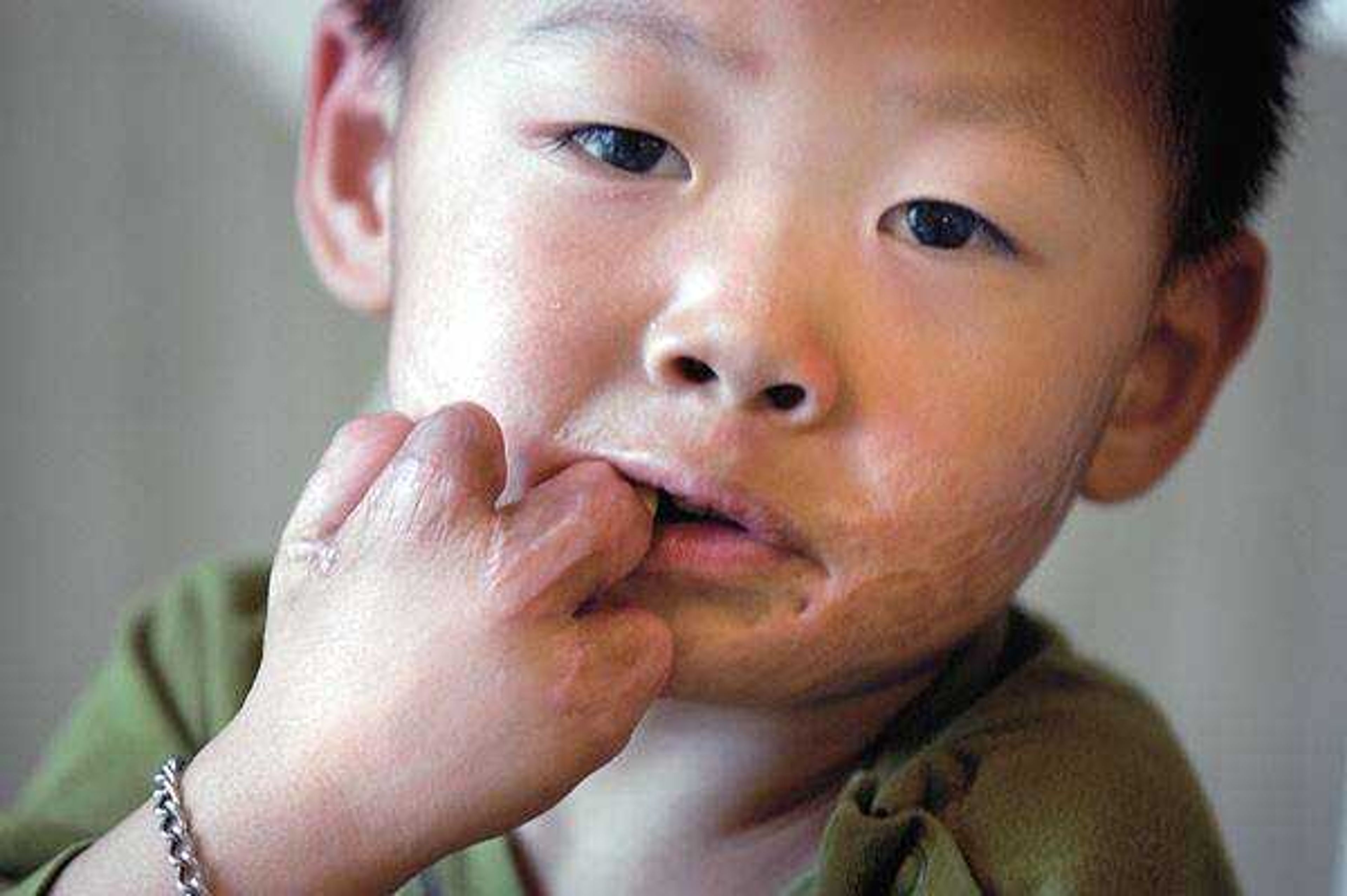 Levi Bentley had cosmetic surgery Friday in Cape Girardeau to correct scar tissue that affects his smile. He is shown here eating candy. (Diane L. Wilson)