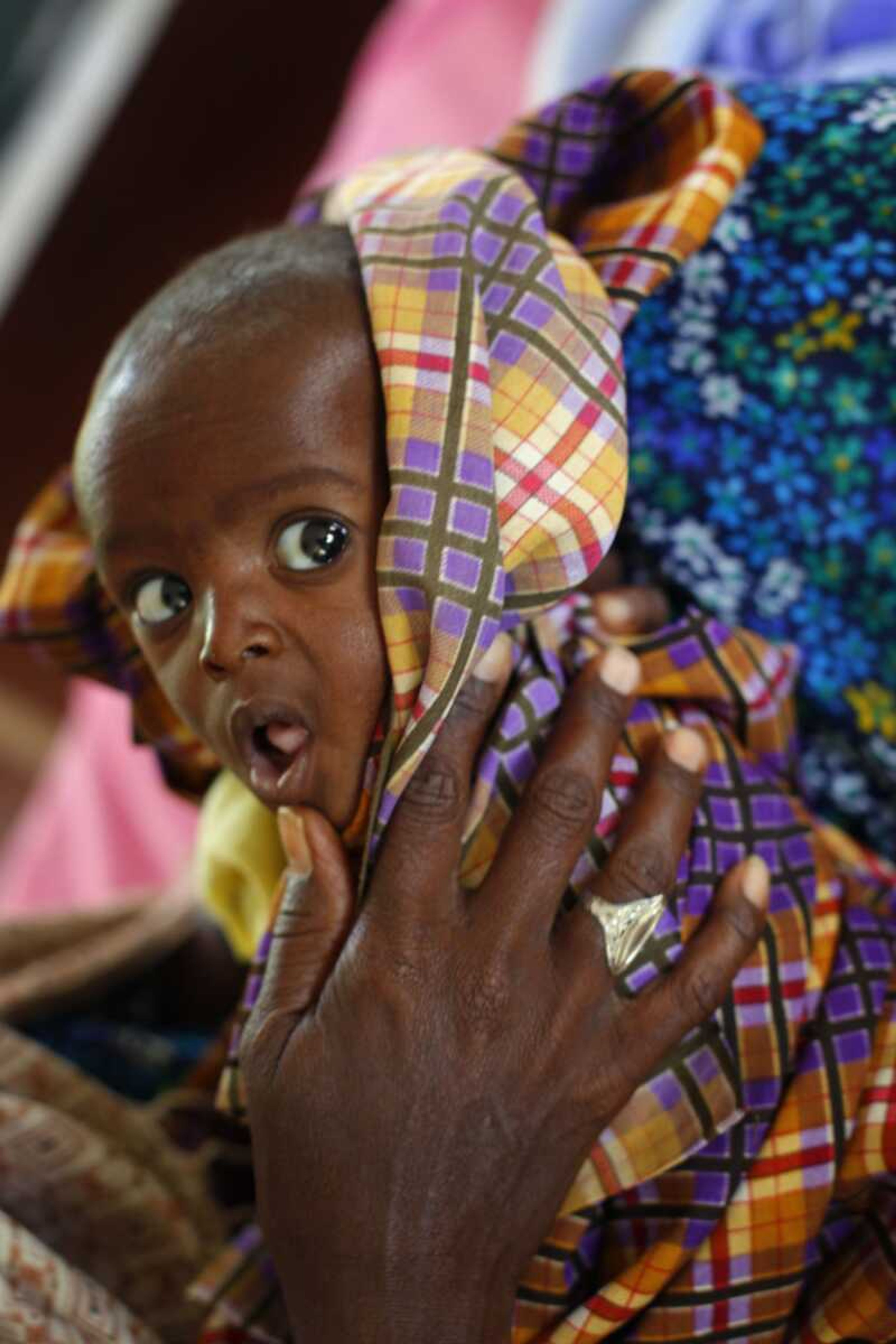 Minhaj Gedi Farah, a 7-month-old child shown Saturday at the International Rescue Committee hospital in the Eastern Kenyan village of Hagadera near Dadaab, has gained more than a pound since his arrival from Somalia on July 26. (Jerome Delay ~ Associated Press)