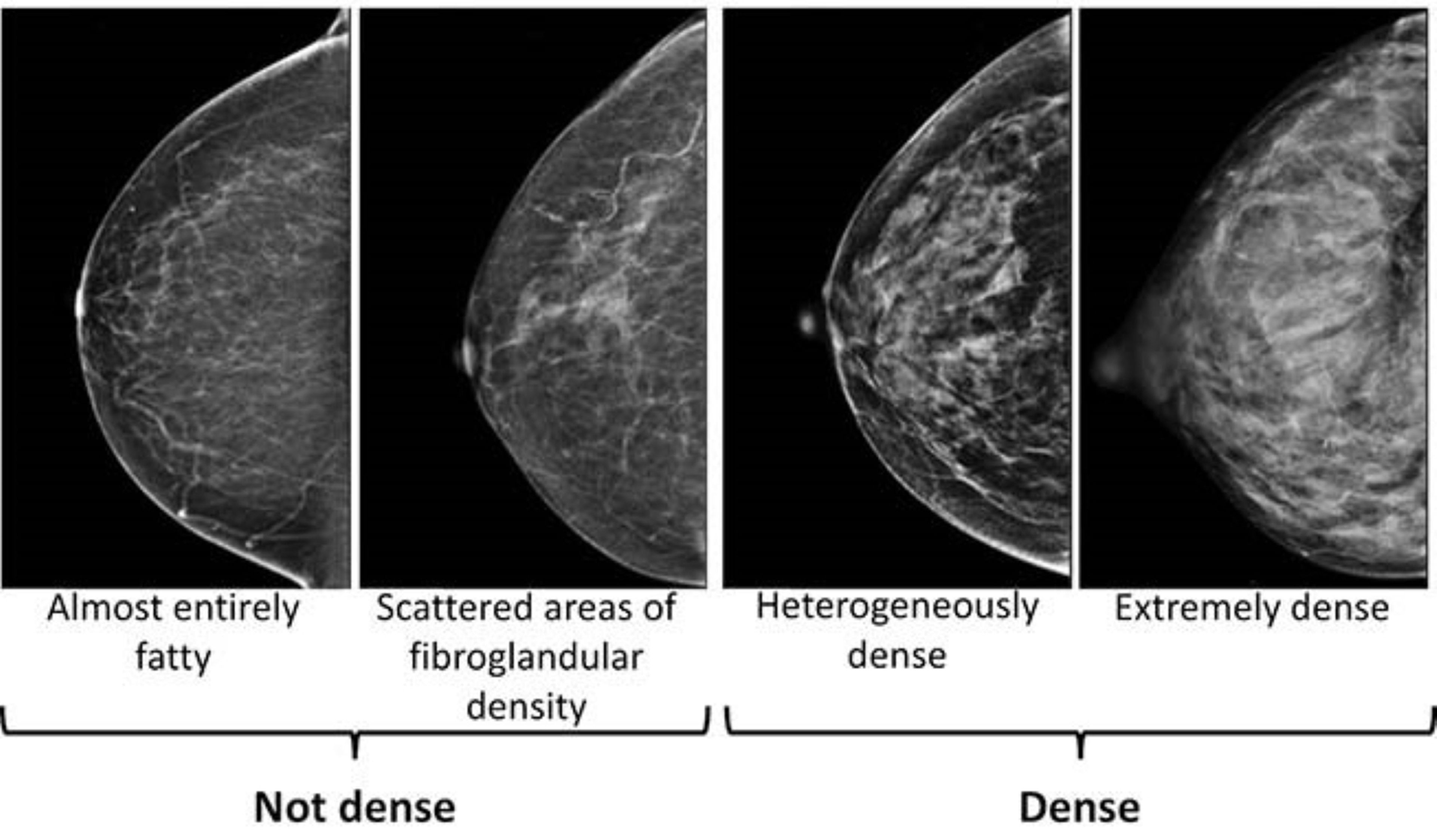 This image provided by the UW/Fred Hutch Cancer Center Breast Imaging in October 2024 shows mammogram scans with dense and not dense tissue. (UW/Fred Hutch Cancer Center Breast Imaging via AP)