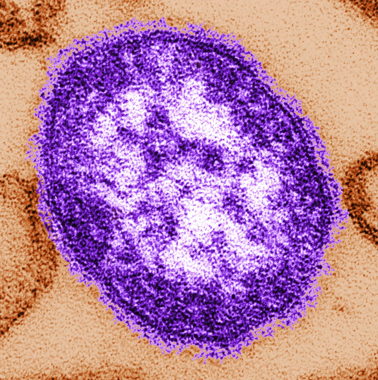 Missouri health officials report measles in New Madrid County as US cases surge   