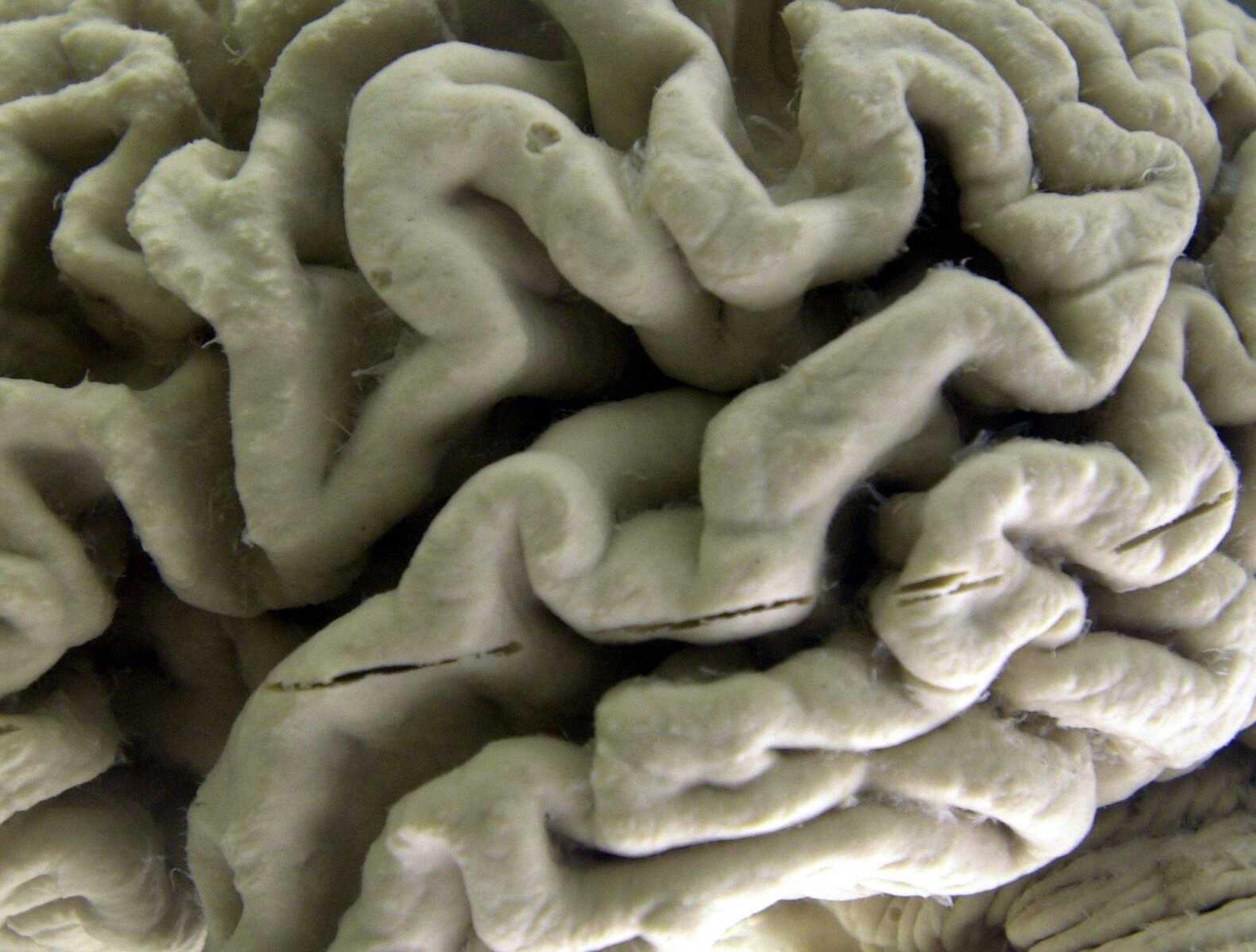 A section of a human brain with Alzheimer's disease is on display at the Museum of Neuroanatomy at the University at Buffalo, in Buffalo, New York.