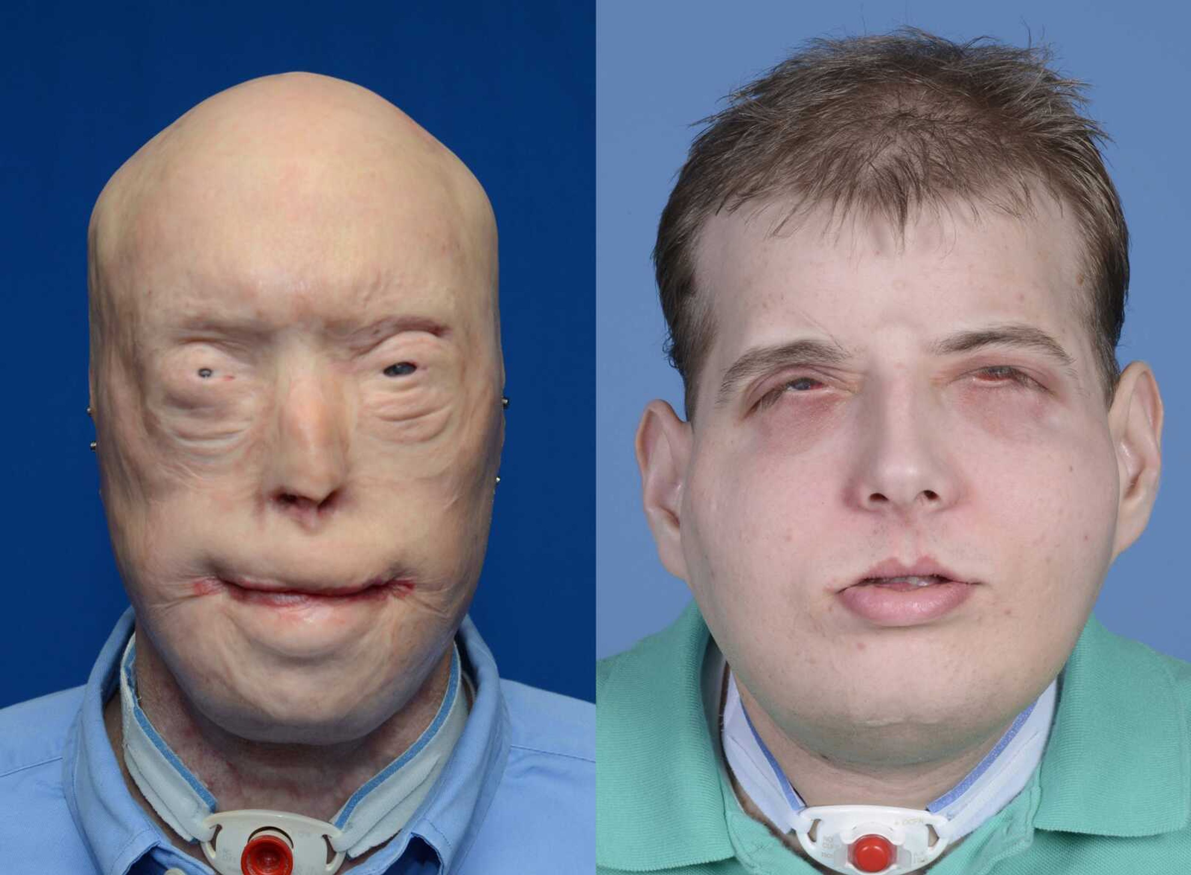 These photos show Patrick Hardison before and after his facial transplant surgery in New York. (Associated Press)