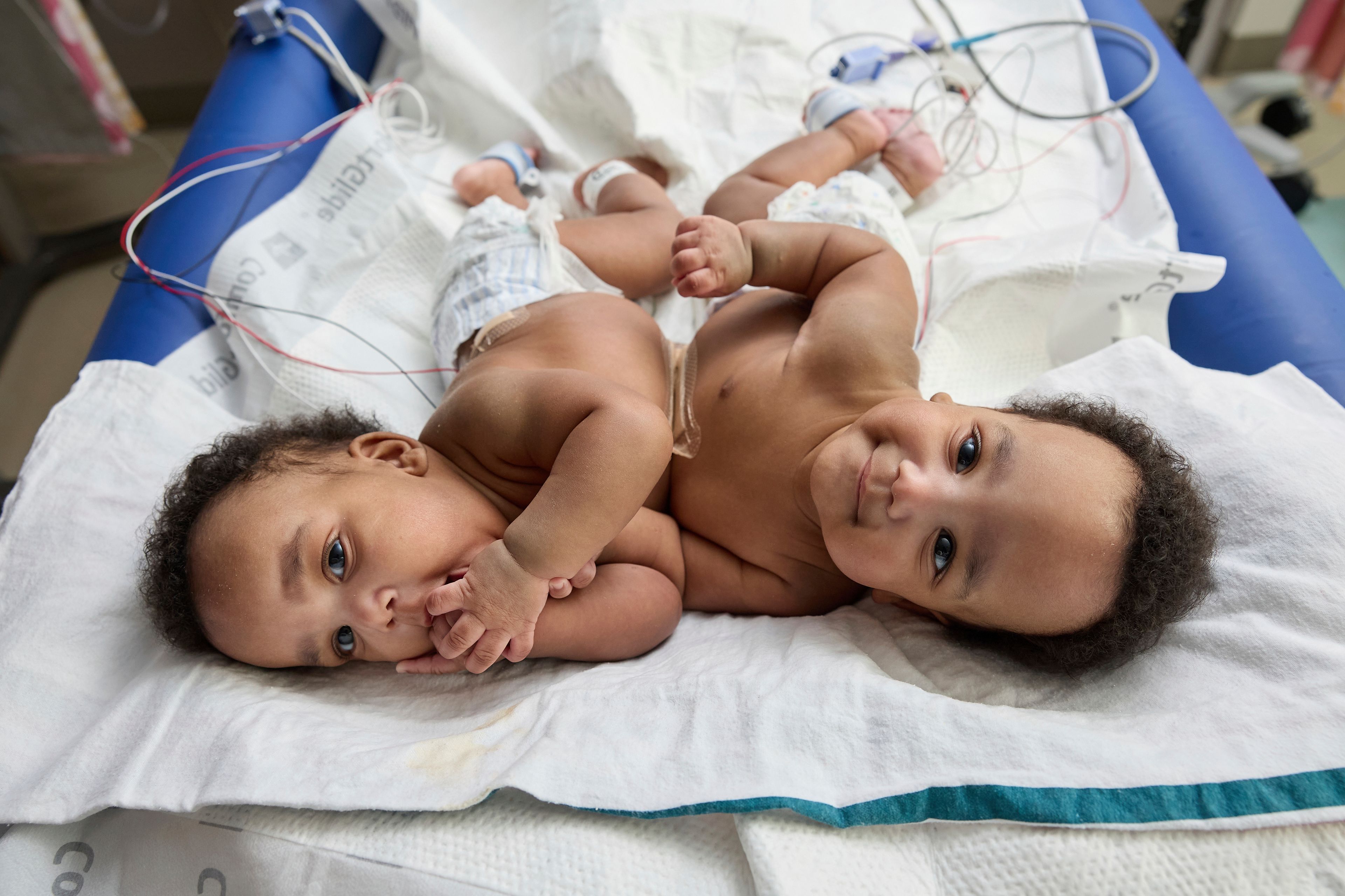 This photo provided by the Children’s Hospital of Philadelphia shows conjoined twins, Amari and Javar Ruffin, at the Children’s Hospital of Philadelphia, March 20, 2024. (Ed Cunicelli/Children’s Hospital of Philadelphia via AP)