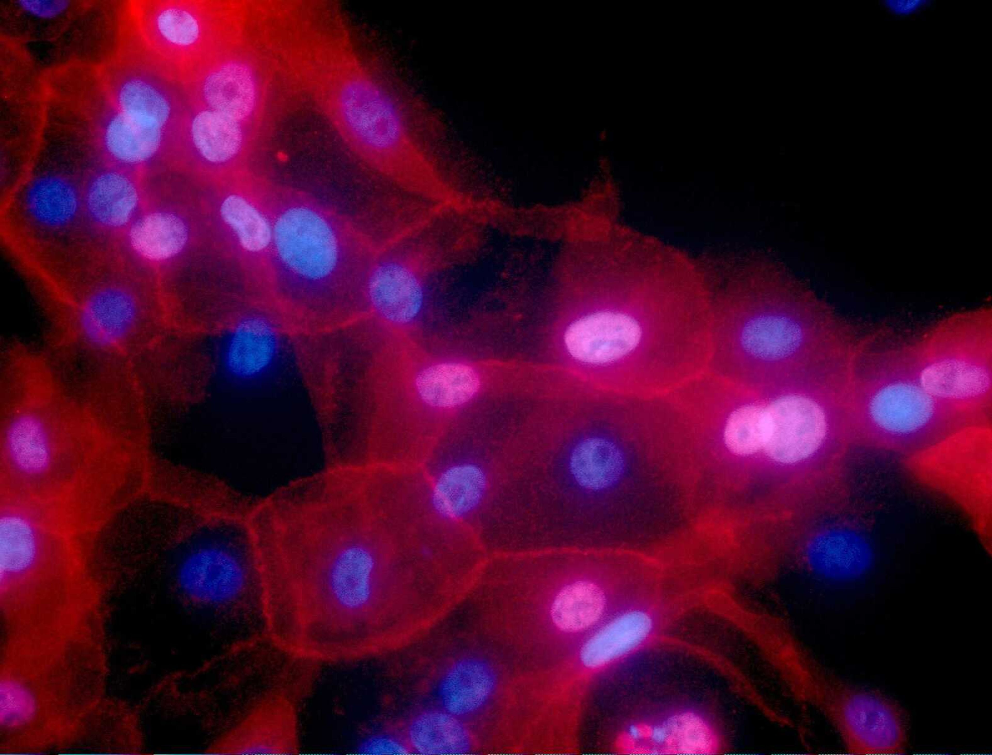 This fluorescence-colored microscope image  shows a culture of human breast cancer cells. A study discussed at the 2022 meeting of the American Society of Clinical Oncology suggests some low-risk breast cancer patients can omit radiation after lumpectomy.