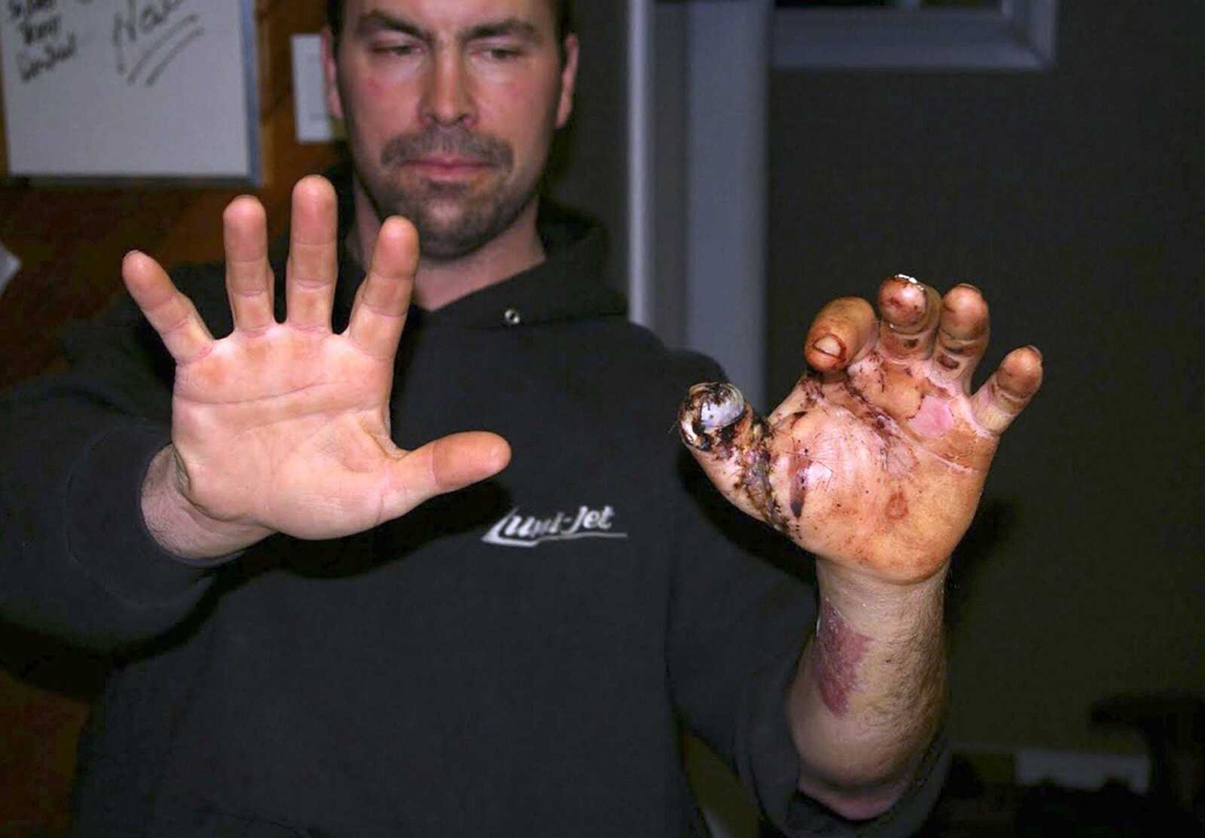 Trent Procter of Swan River, Manitoba, Canada, shows his hands during his 2010 rehabilitation, months after his Savage Arms stainless steel 10ML-II muzzleloader exploded and severely injured his left hand.