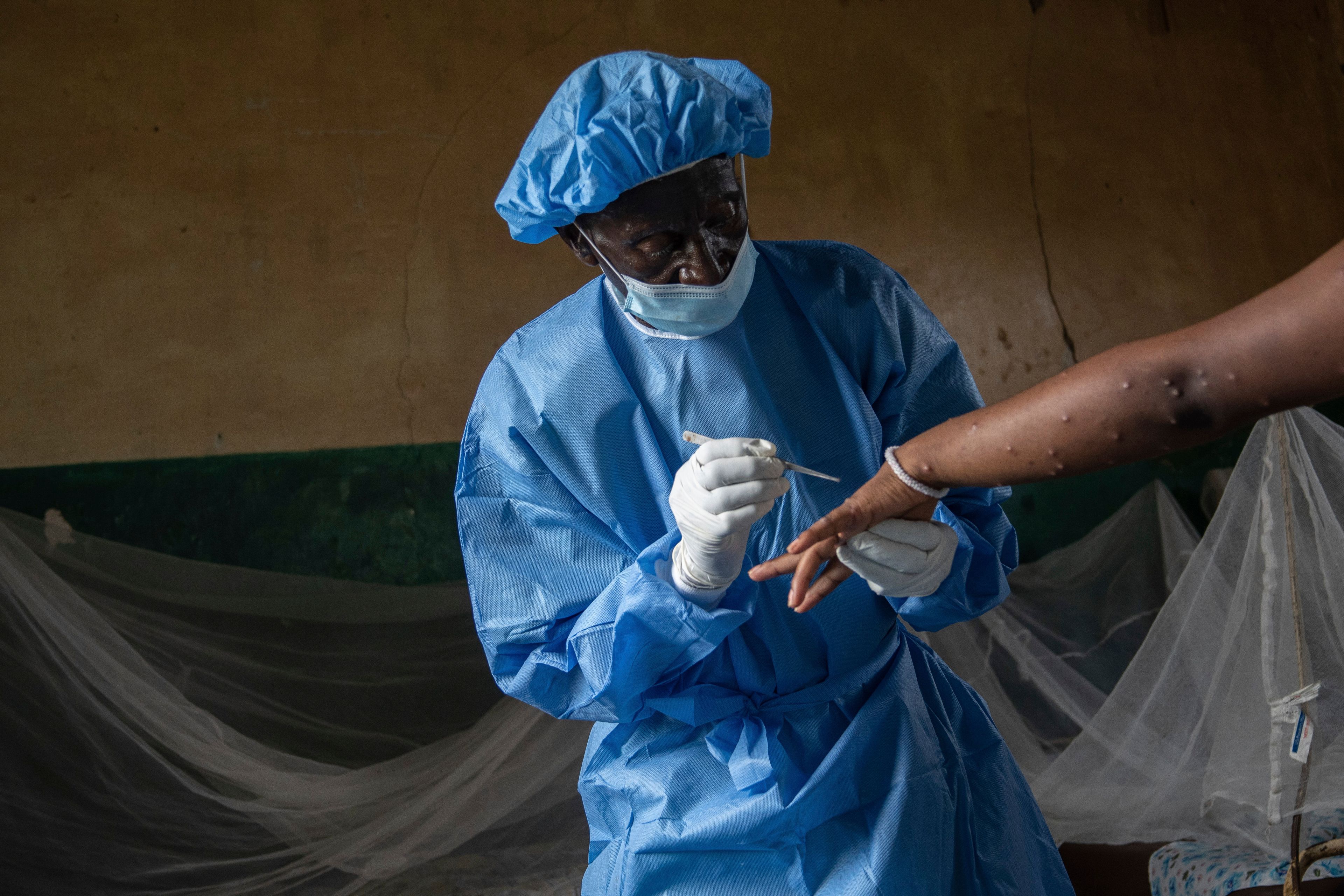 Atumisi Anaclet treats a sex worker with mpox on Sept. 4, 2024, in a hospital in Kamituga, in eastern Congo's South Kivu province, which is the epicenter of the world's latest outbreak of the disease. (AP Photo/Moses Sawasawa)