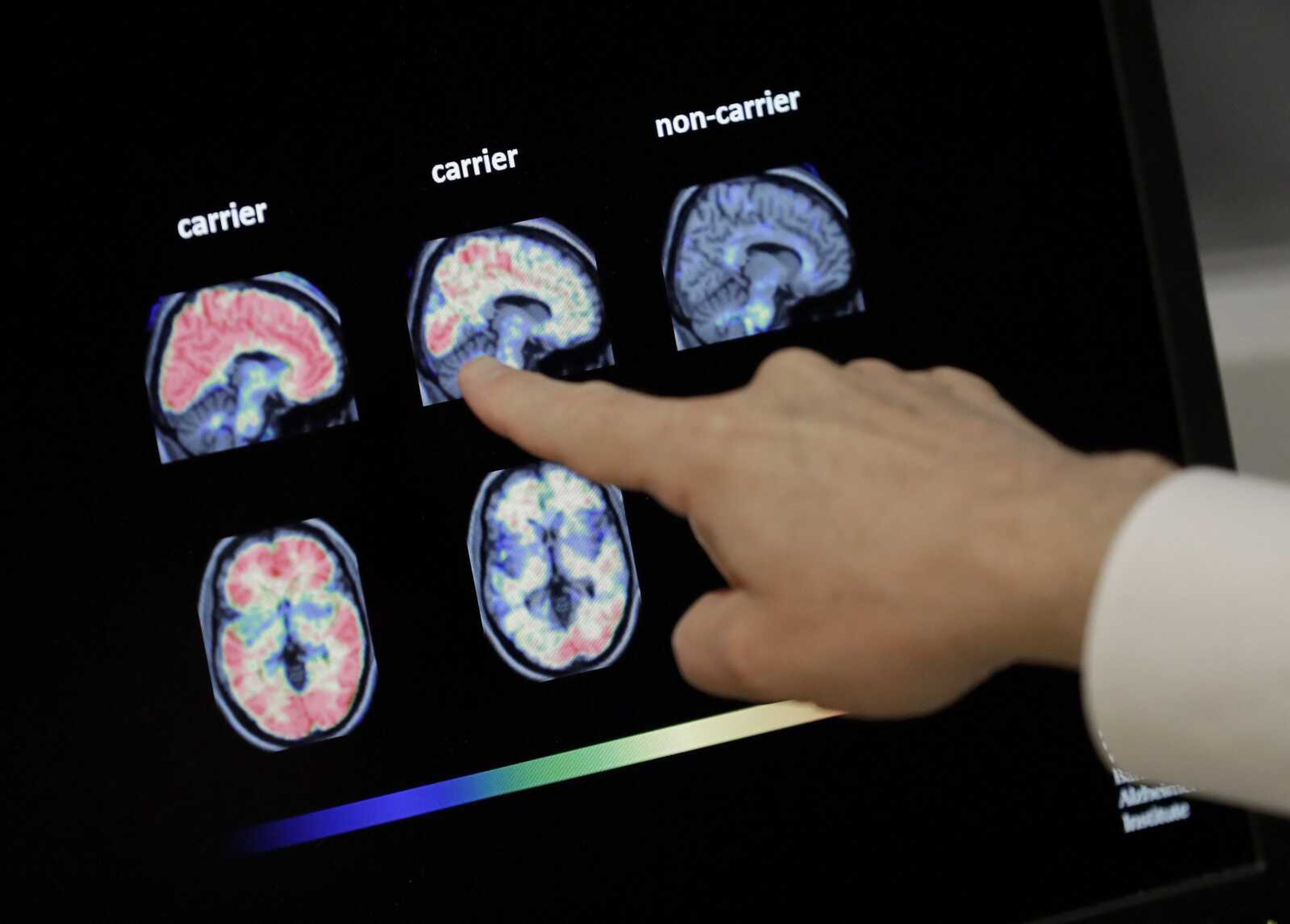 Dr. William Burke goes over a PET brain scan at Banner Alzheimer's Institute in Phoenix in August 2018. The drug company Biogen Inc. says it will seek federal approval for a medicine to treat early Alzheimer's disease, a landmark step toward finding a treatment that can alter the course of the most common form of dementia.