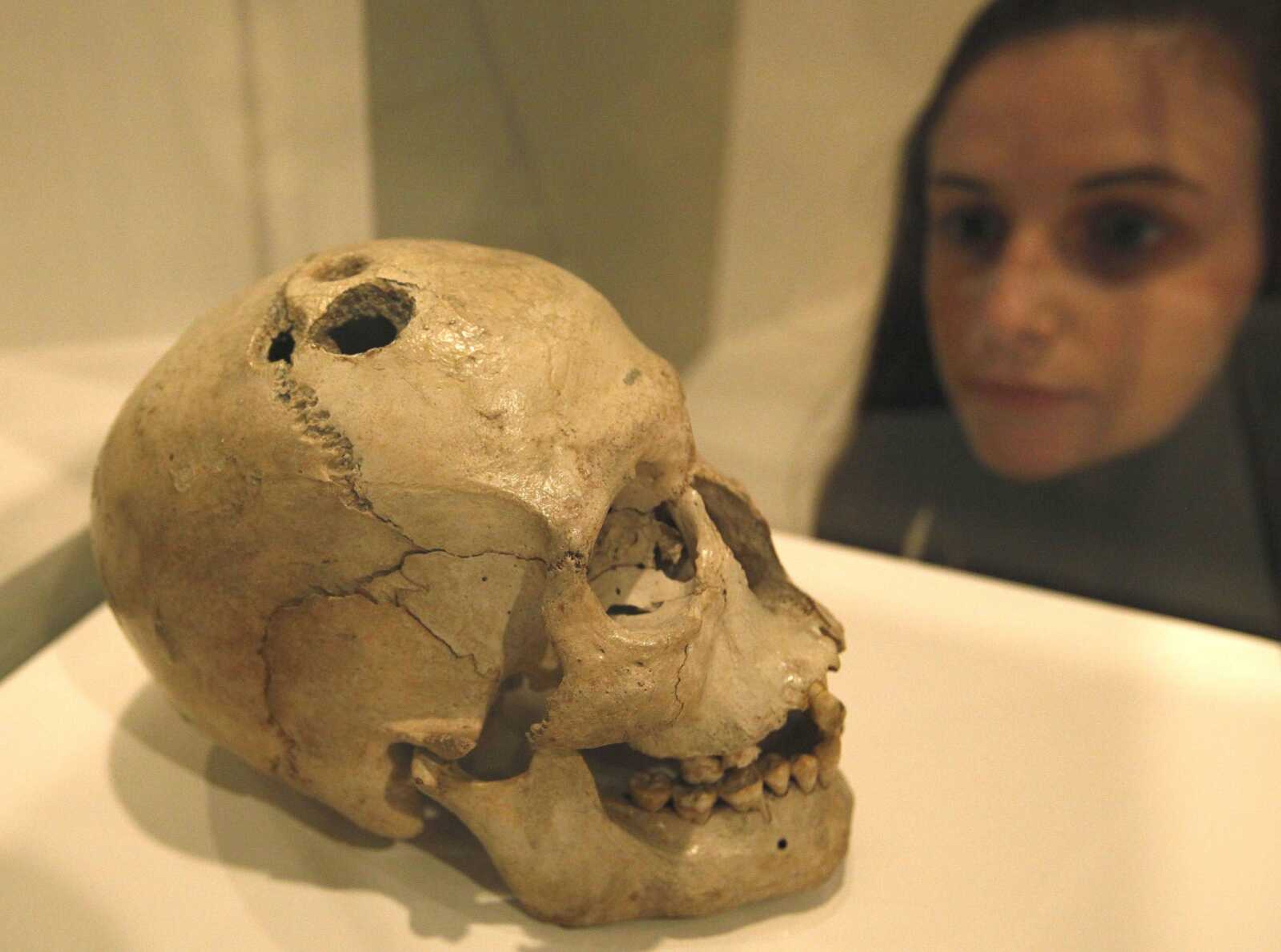 A Bronze Age skull from Jericho in the West Bank that shows four holes made by the ancient surgical procedure of trephination is on display Tuesday at the exhibition "Brains: The Mind as Matter" at the Wellcome Collection in London. (Alastair Grant ~ Associated Press)