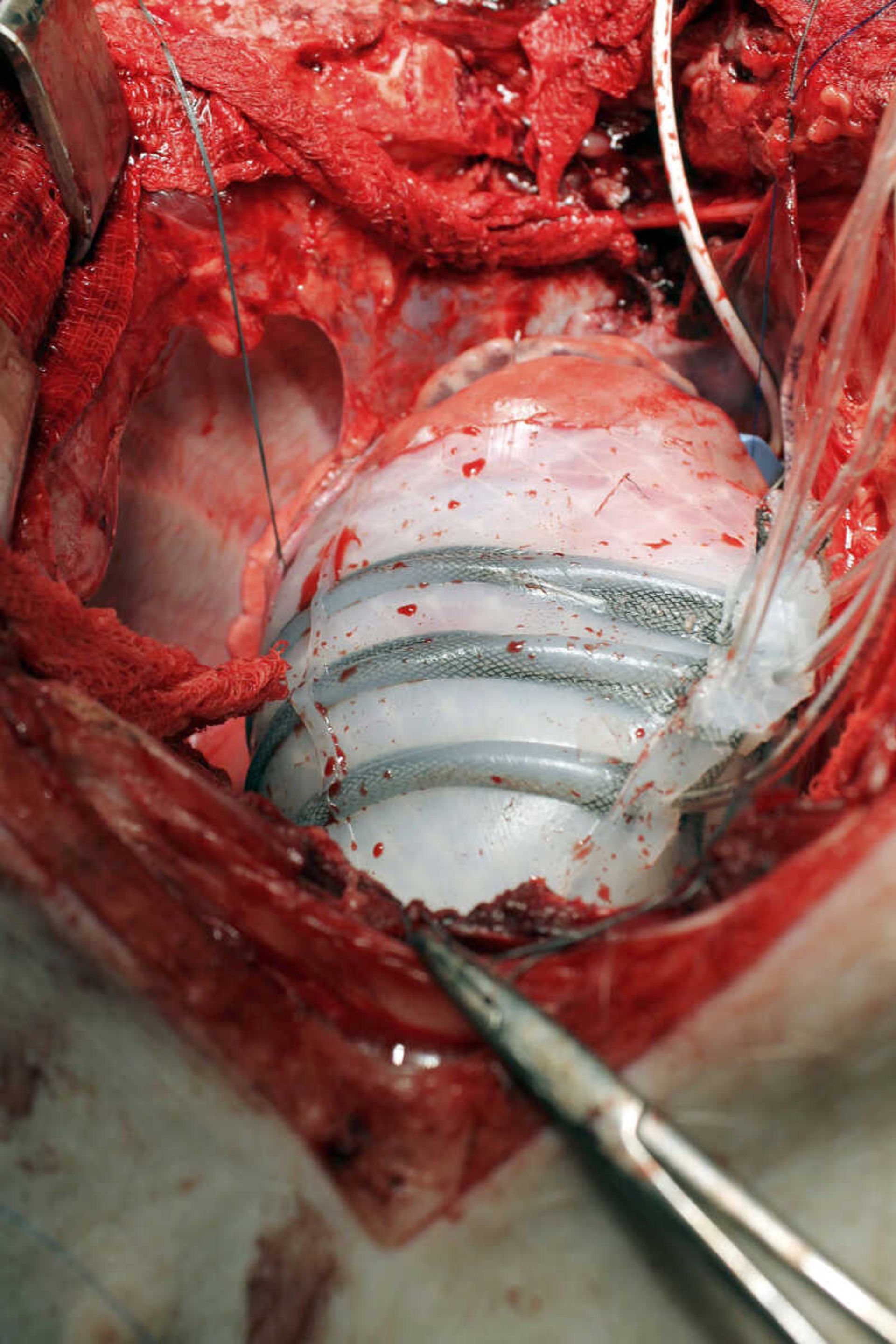 This photo shows a pig's heart encased in a robotic sleeve designed to gently squeeze a diseased heart so it better pumps blood.