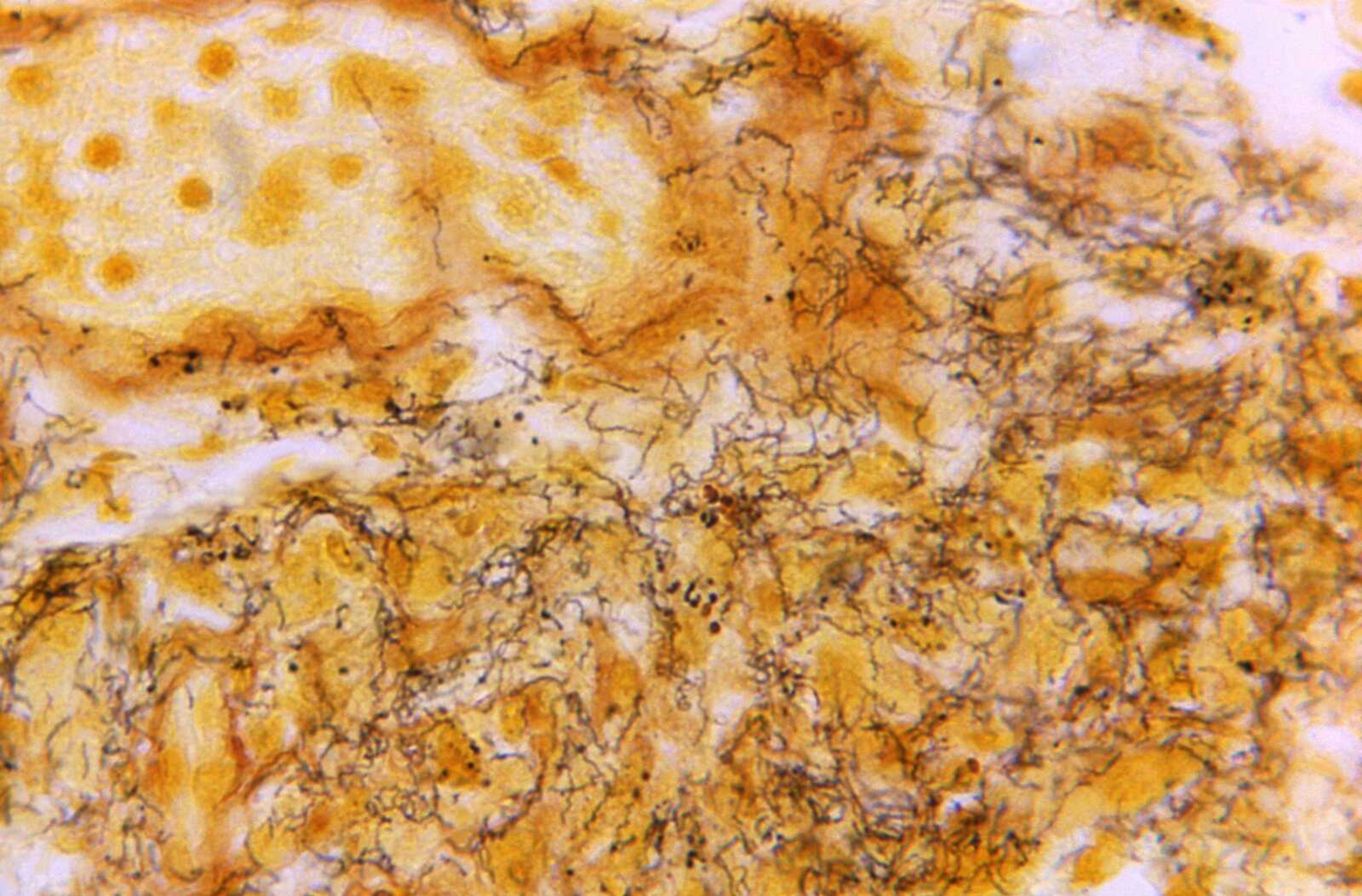 This 1966 microscope photo shows a tissue sample with the presence of numerous, corkscrew-shaped, darkly-stained, Treponema pallidum spirochetes, the bacterium responsible for causing syphilis. U.S. health officials on Monday called for a new push to prevent sexually transmitted diseases -- spurred in part by a 26% increase in syphilis cases last year.