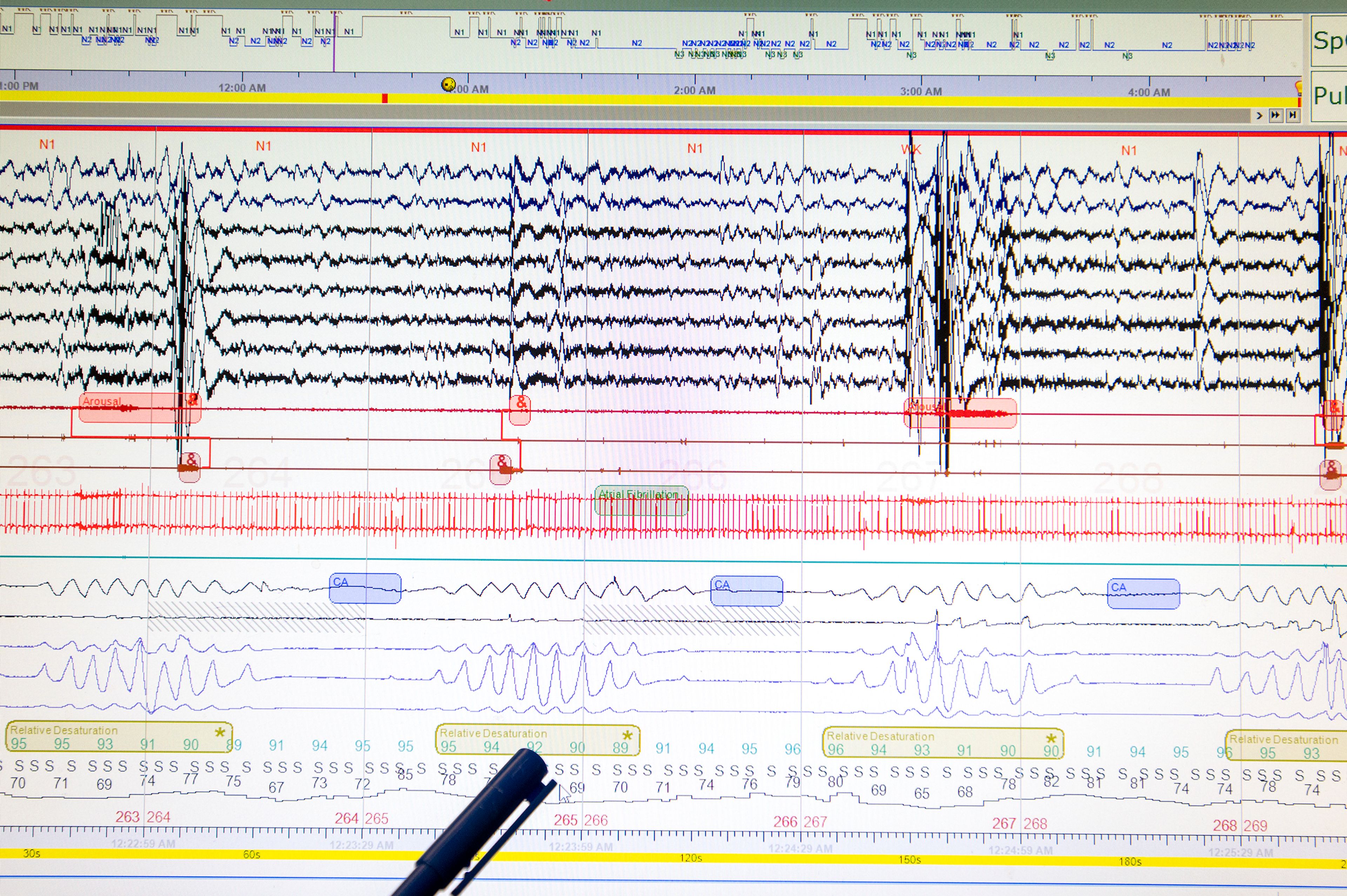 Dr. Preetha Rosen identifies abnormal sleeping patterns from a chart at Gritman Medical Center in Moscow.